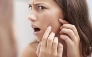 5 Amazing Ways to Prevent Acne