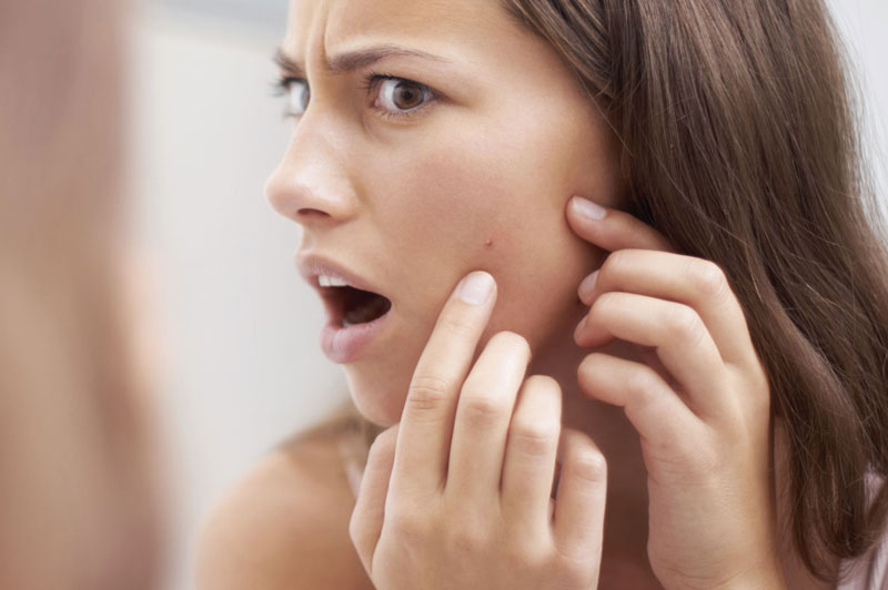 5 Amazing Ways to Prevent Acne