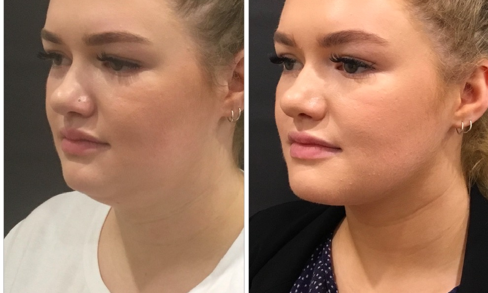 CoolSculpting Chin