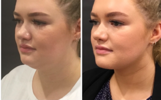 CoolSculpting Chin