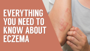 Everything you need to know about eczema