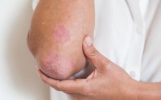 Eczema Treatment