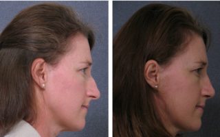 Dr Hodgkinson - brow lift surgery Sydney