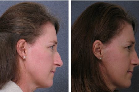 Dr Hodgkinson - brow lift surgery Sydney