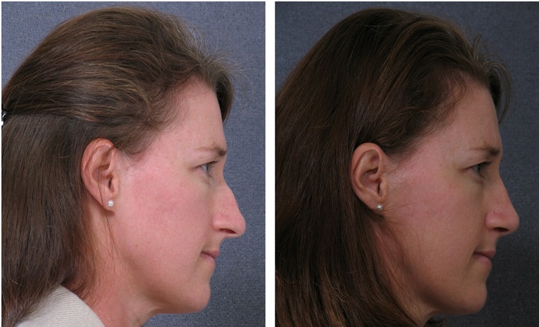 Dr Hodgkinson - brow lift surgery Sydney