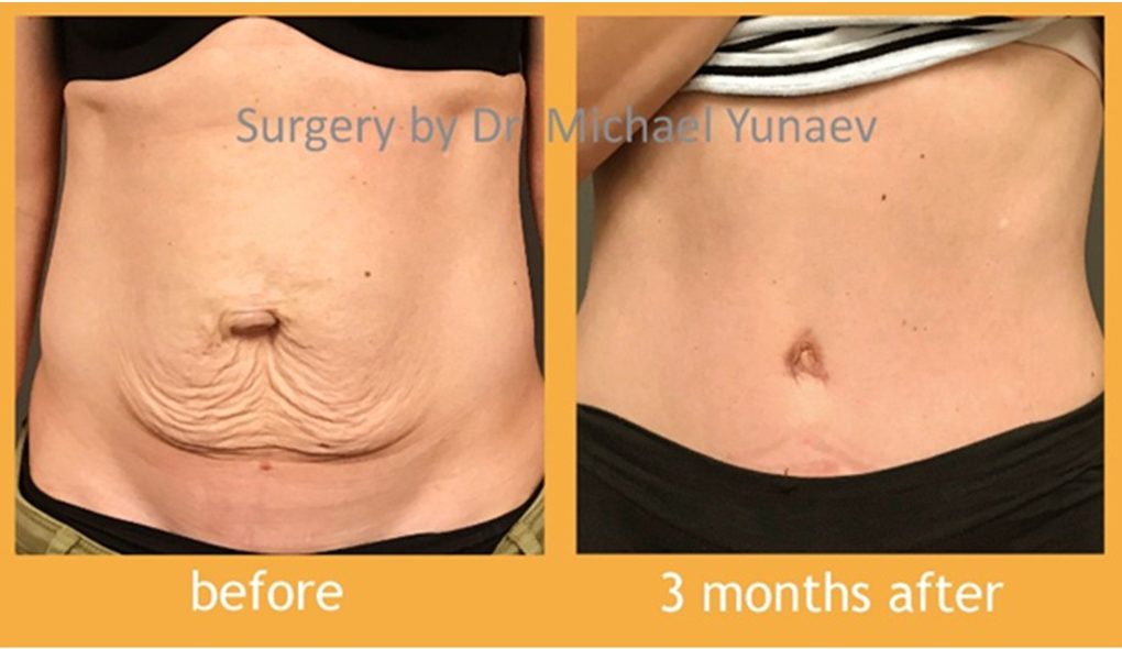 Tummy Tuck And Breast Augmentation Procedure