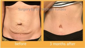 Tummy Tuck And Breast Augmentation Procedure