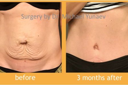 Tummy Tuck And Breast Augmentation Procedure