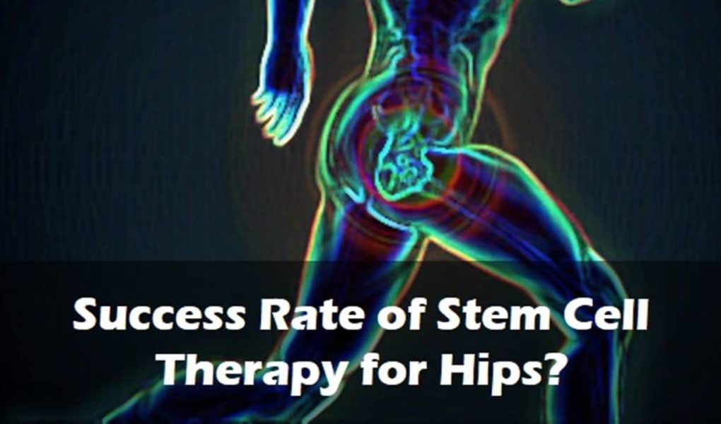 Success Rate of Stem Cell Therapy for Hips