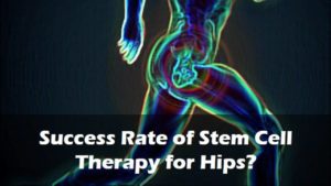 Success Rate of Stem Cell Therapy for Hips