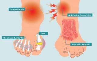 Arch Of The Foot Pain: Causes