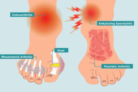 Arch Of The Foot Pain: Causes