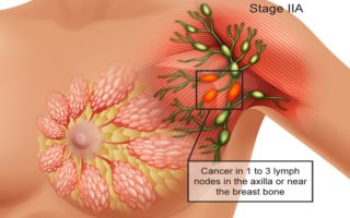 The Risk Factors to Prevent Breast Cancer
