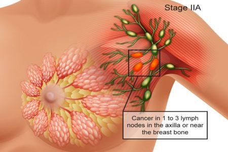 The Risk Factors to Prevent Breast Cancer