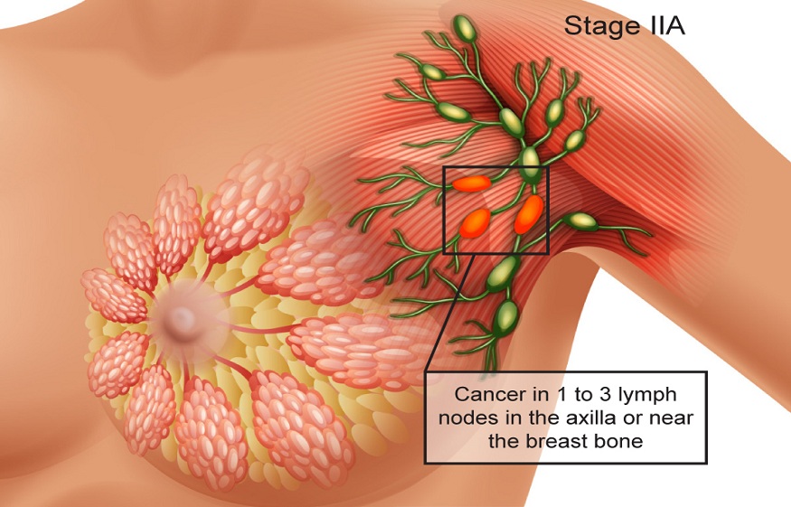 The Risk Factors to Prevent Breast Cancer