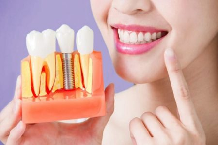 Why You Should Get Dental Implants