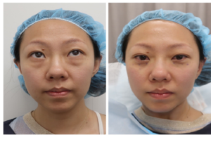 Blepharoplasty Surgery And Why It Is Done