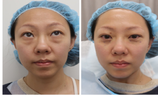 Blepharoplasty Surgery And Why It Is Done