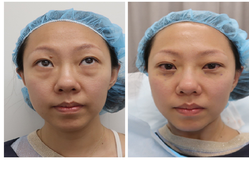 Blepharoplasty Surgery And Why It Is Done