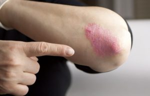 LIFESTYLE PRACTICES YOU CAN ADOPT TO MANAGE PSORIASIS SKIN CONDITION