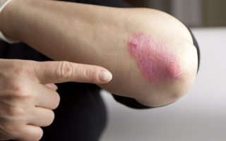 LIFESTYLE PRACTICES YOU CAN ADOPT TO MANAGE PSORIASIS SKIN CONDITION