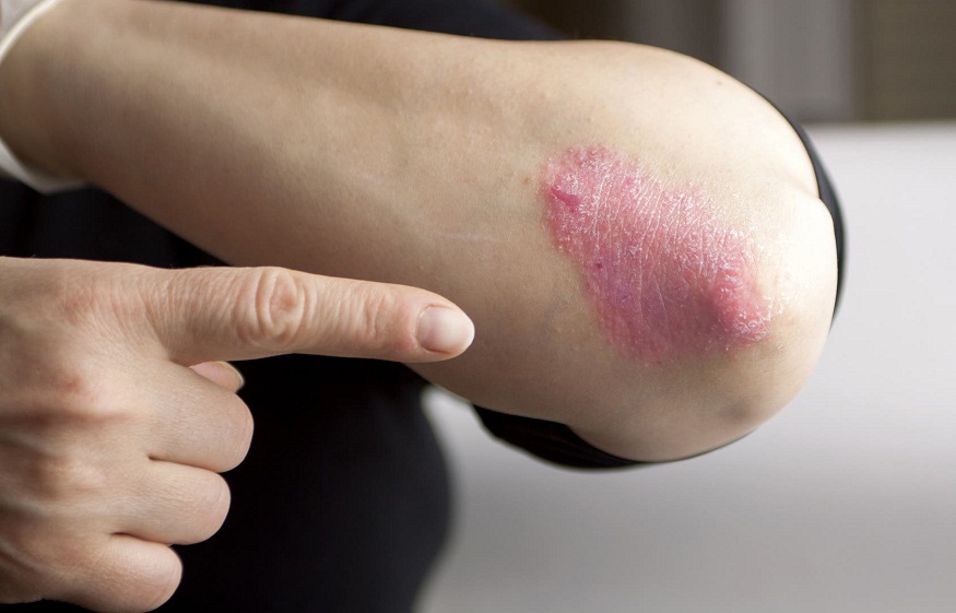 LIFESTYLE PRACTICES YOU CAN ADOPT TO MANAGE PSORIASIS SKIN CONDITION