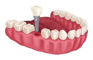 Can a Dentist Tell if You Have Diabetes