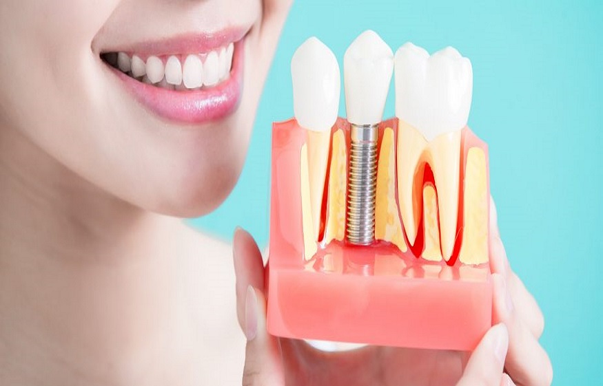 Get the Best Dental Treatment Benefits from Dental Implant Clinic