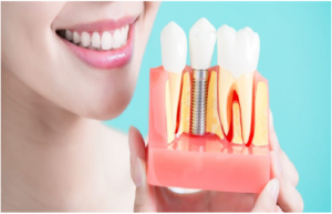 How to Choose a Professional Dental Implants Clinic