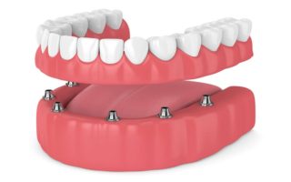 Type of Denture