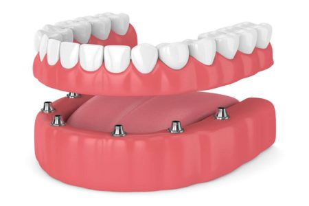 Type of Denture