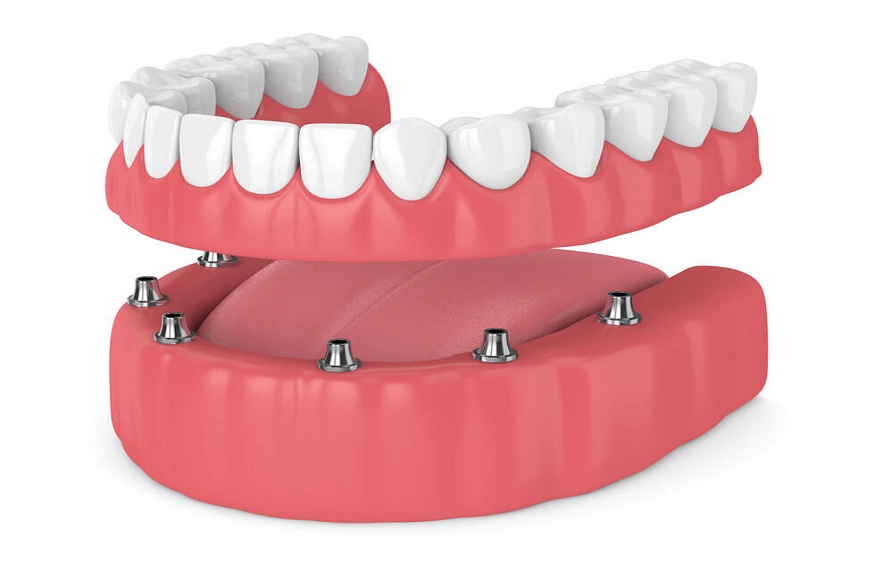 Type of Denture