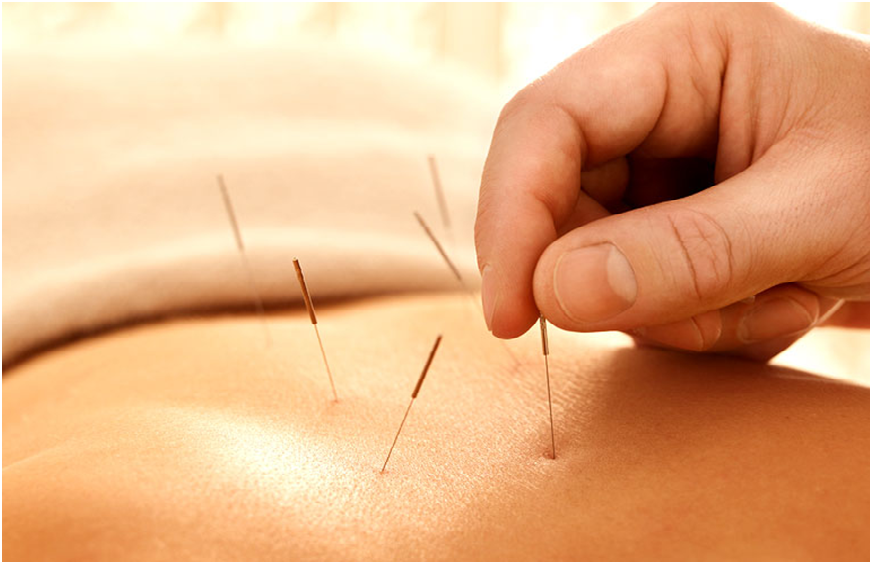 Acupuncture Before Visiting a Clinic in Richmond