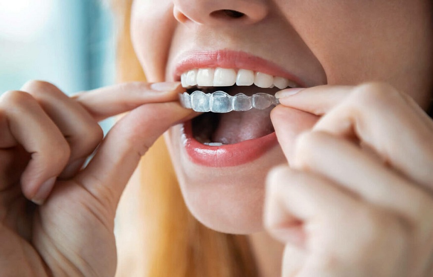 Invisalign