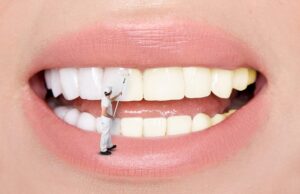 Getting Porcelain Veneers