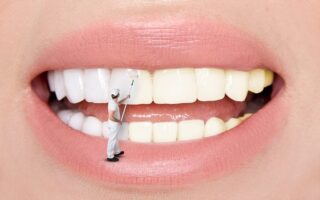 Getting Porcelain Veneers