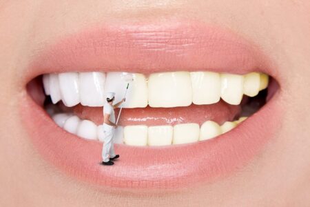 Getting Porcelain Veneers