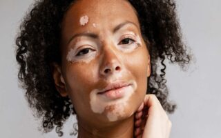 pigmentation,