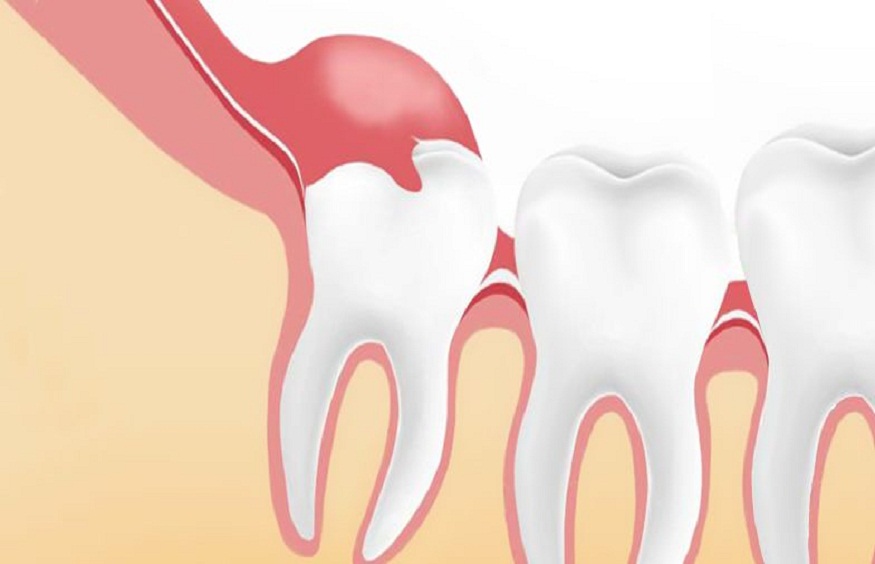 Cheap wisdom teeth removal
