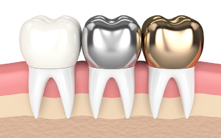  dental crowns for back teeth