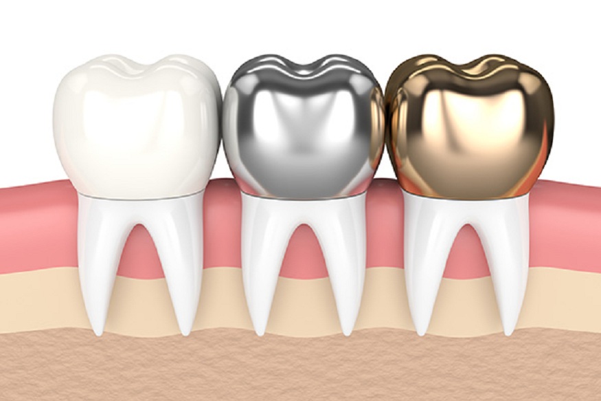  dental crowns for back teeth