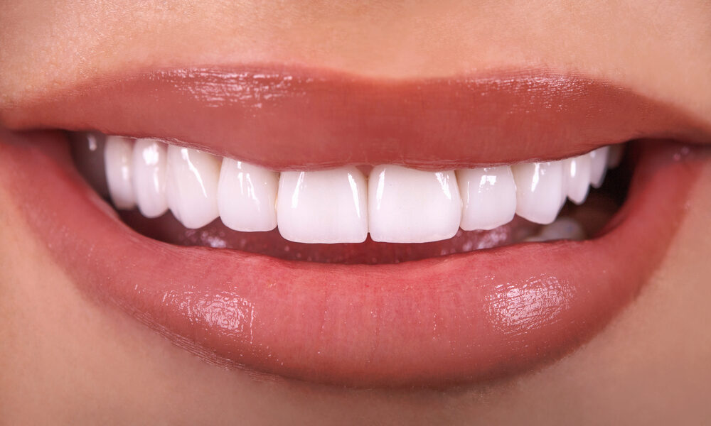 Dental Veneers