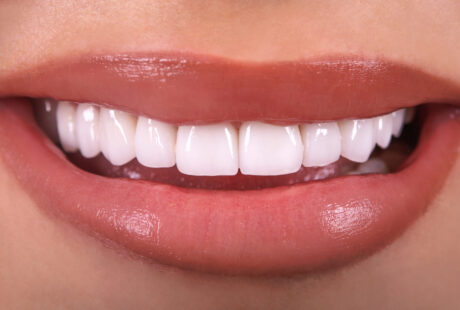 Dental Veneers