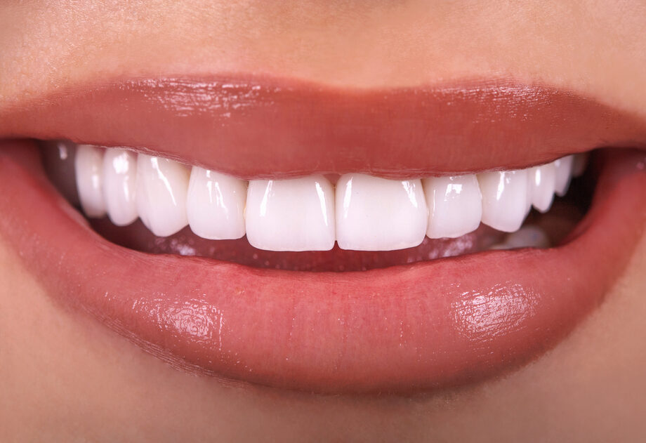 Dental Veneers